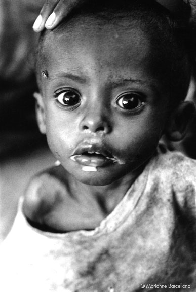 Starving Child in Somalia, for AmeriCares